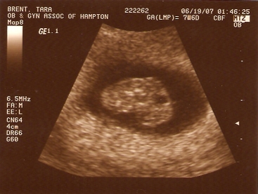 Tara's first ultrasound
